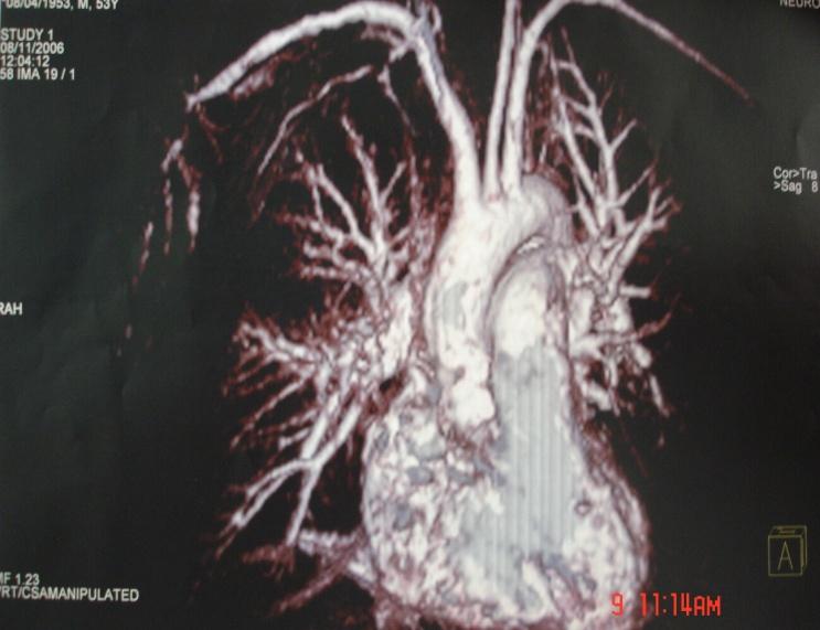 CT Angiography - tridimensional multislice scan, which emphasizes the irregularities of pulmonary vessels