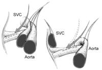 Surgical technique. The surgery is done by ECC median sternotomy. The ascending aorta, superior and inferior vena cava and right sides of the cannula occlusion are cannulated.