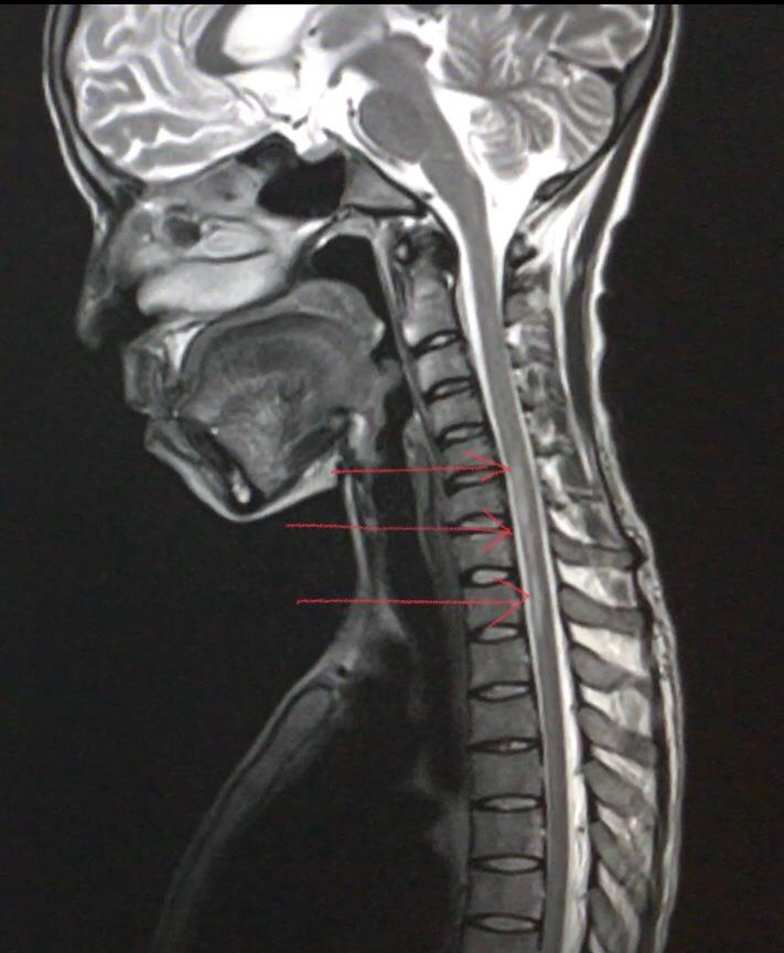 MRI angio showing anterior spinal