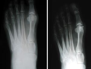 The x ray on the left shows severe arthritis of the MTP joint. After arthrodesis (shown on the right), the entire foot is realigned.