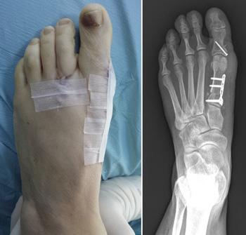 (Left) The bunion that was shown at the beginning of this article as it appeared immediately after surgery. (Right) An x ray showing the bones in alignment after surgery.