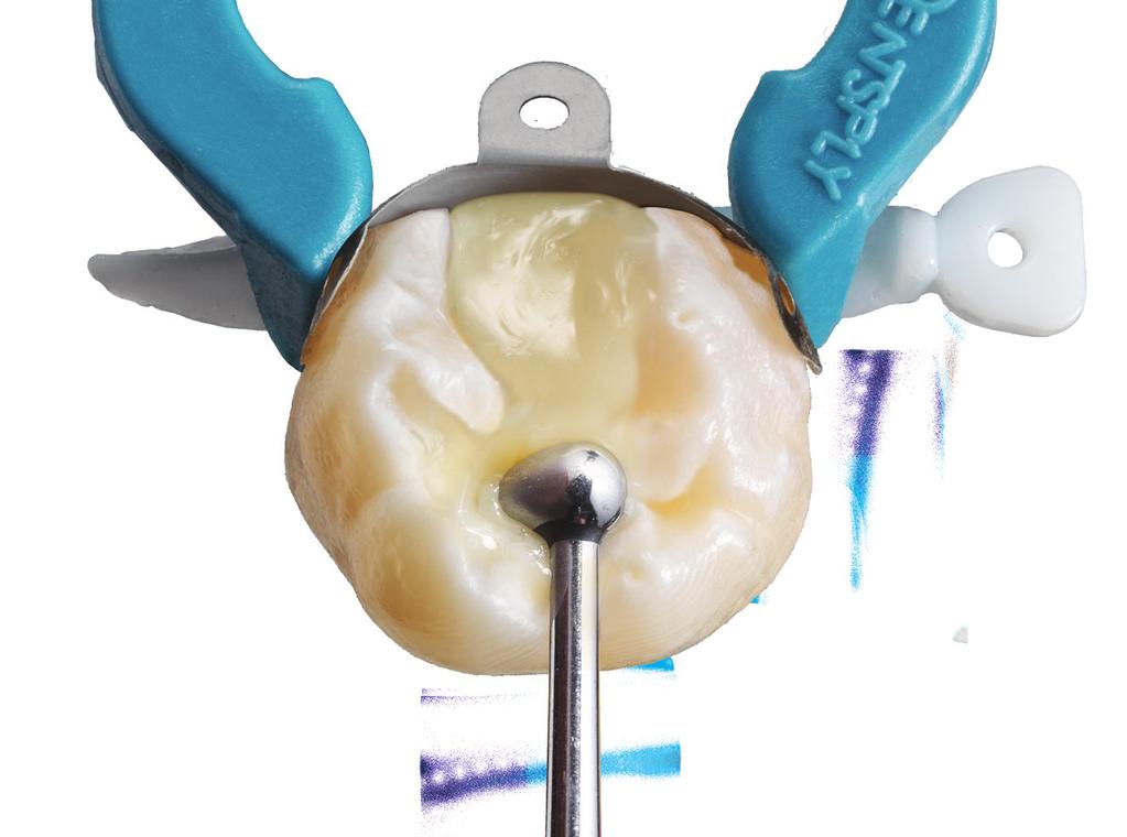 A SIMPLER WAY TO FINISH S I M P L I F Y T H E S H A D E S E L E C T I O N P R O C E S S 80%+ OF PATIENTS ARE REPORTEDLY AWARE OF COLOR DIFFERENCES BETWEEN RESTORED AND ADJACENT NATURAL TEETH.