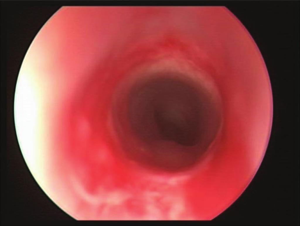 Upon extubation, she developed stridor and increased work of breathing. Airway examination documented Grade III, soft subglottic stenosis and balloon dilation was performed.