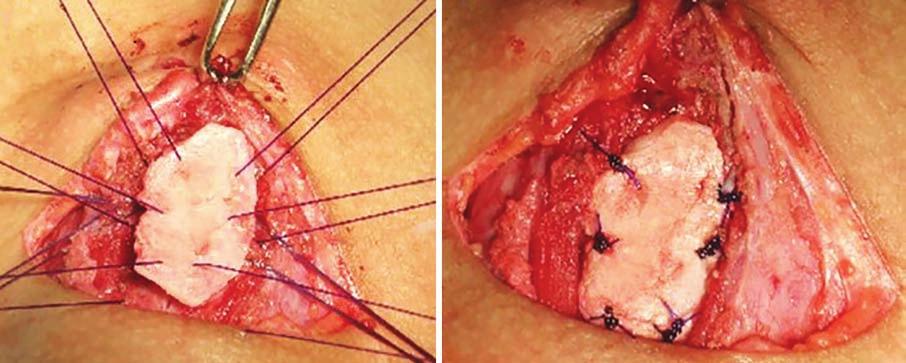 ijhns Role of Autologous Costal Cartilage Grafts in Otolaryngology Practice Fig. 4: Placement of anterior costal cartilage graft in the pocket. Suction drain was inserted and wound closed.