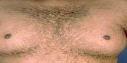 Terra firma-forme dermatosis Dirt-like plaques develop on the skin despite normal hygiene Terra firma means