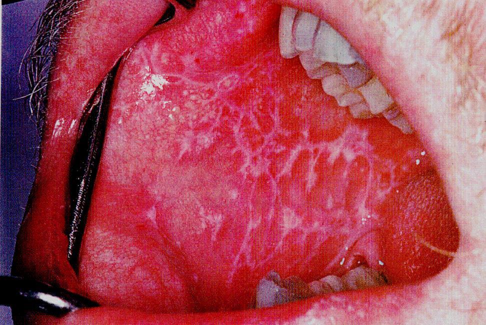 Lichen Oris According to Grynspan et al. (1963) lichen oris can be found in 36,4% of diabetic patients.