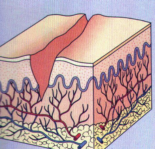 Fissure (secondary lesion) A