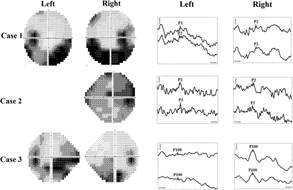 Zhao et al. BMC Neurology (2018) 18:159 Page 5 of 7 Fig. 4 Visual fields and FVEP/PVEP of the 3 cases. Left, Humphrey visual field plots of both eyes.