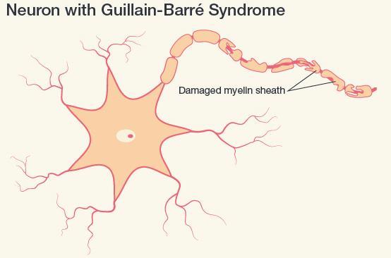 GBS is an uncommon sickness of the nervous system in