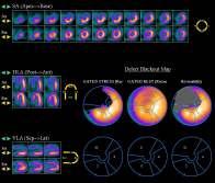Myocardial Perfusion Imaging Exercise SPECT Strengths SPECT Myocardial Perfusion Imaging Extensively validated, useful for cost-effective risk stratification & patient management.