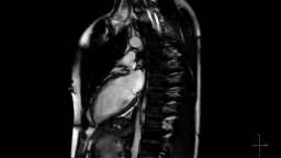 Indications for MRI Quantifying left and right ventricular function Cardiomyopathy Heart failure Arrythmogenic right ventircular dysplasia (ARVD) Pulmonary