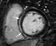 Myocarditis Myocarditis: Delayed enhanced imaging demonstrate enhancement in the mid-myocardium often in a patchy pattern