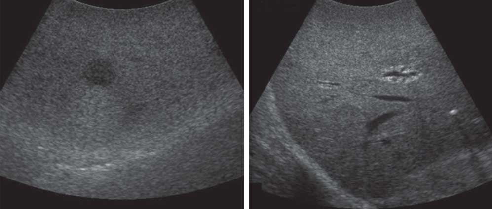 A B Figure 1. Intraoperative ultrasonographic images of hepatic colorectal metastases. Circles indicate outer boundaries of lesions.