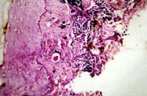K.P. Karumbaiah & S. Shivakumar / A Histopathologic Study of Connective Tissue Diseases of Skin 395 Fig. 1: Discoid lupus erythematosus showing basement membrane thickening (PAS, 10x10) Fig.