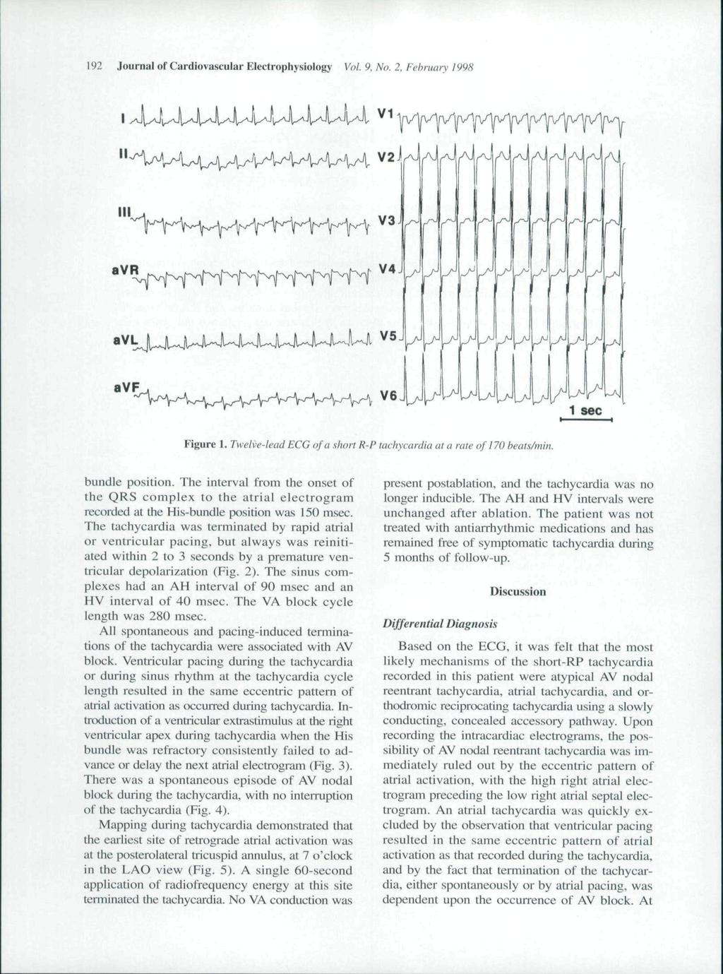 192 Journal of Cardiovascular Electrophysiology Vol. 9. No. 2. February 1998 avr avl avf Figure 1. Twelve-lead ECG of a short R-P tachycardia at a rate of i 70 beats/min. bundle position.