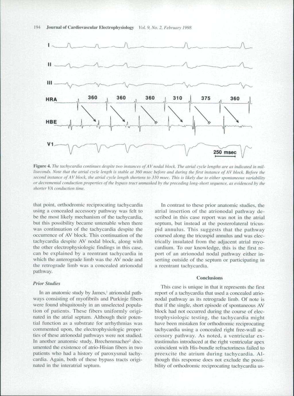 194 Journal of Cardiovascular Electrophysiology Vol. 9. No. 2, February 1998 Figure 4. The tachycardia continues despite two instances of A V nodal block.