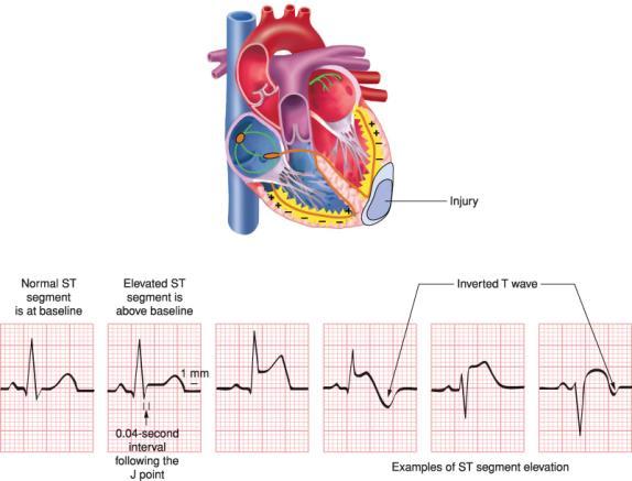 ST Segment Elevation Earliest reliable sign that myocardial infarction has occurred I 19 Landscape of an MI cont.