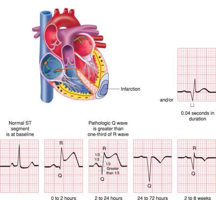 Pathologic Q Waves Indicate presence of irreversible myocardial damage or myocardial infarction I 23 Landscape of an MI cont.