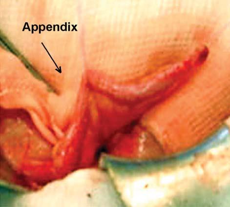 Figure 1 The appendix was divided into two parts in order that its proximal part was utilized for intestinal catheterization and its distal part as a Mitrofanoff