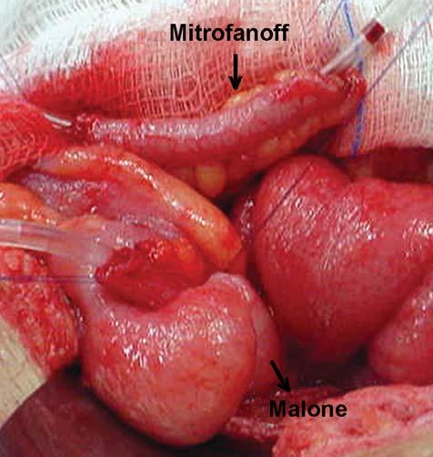 (Mitrofanoff (3)); 1 patient: sigmoidoplasty to reduce its caliber; 1 patient: plastic surgery on the bladder neck; 1 patient: reconstruction of the intestinal