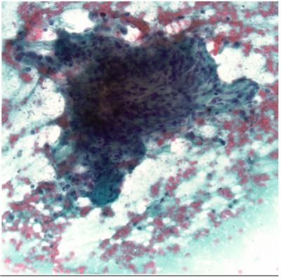 Figure 2b The aspirate smears reveal groups of crowded cells with scant cytoplasm, background fibrin, a large number of reactive-appearing pneumocytes with background histiocytes and few giant cells 