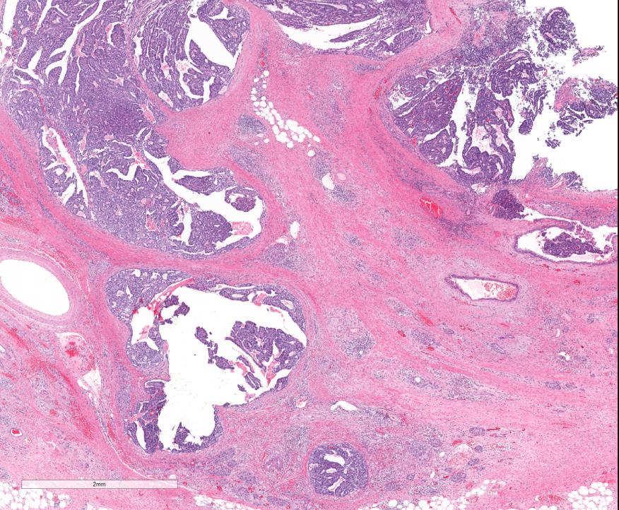 Intraductal tubulopapillary neoplasm Intraductal growth Circumscribed nodules of back-to-back
