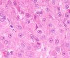 to moderate eosinophilic to amphophilic cytoplasm Acinar cell carcinoma Solid with