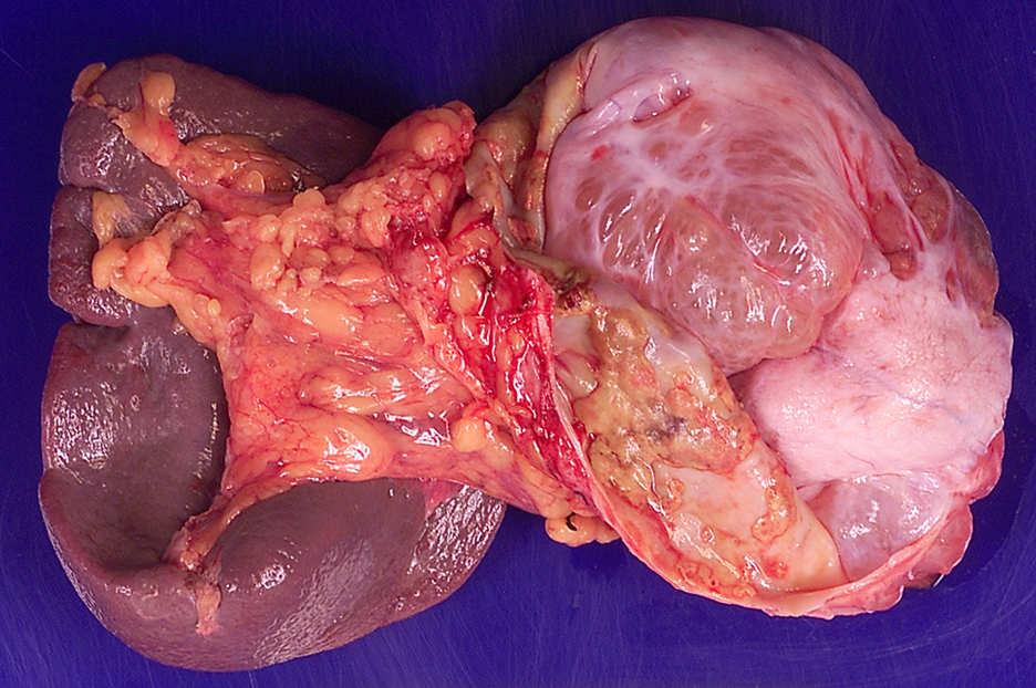 Mucinous cystic neoplasm Pancreatic neuroendocrine tumor