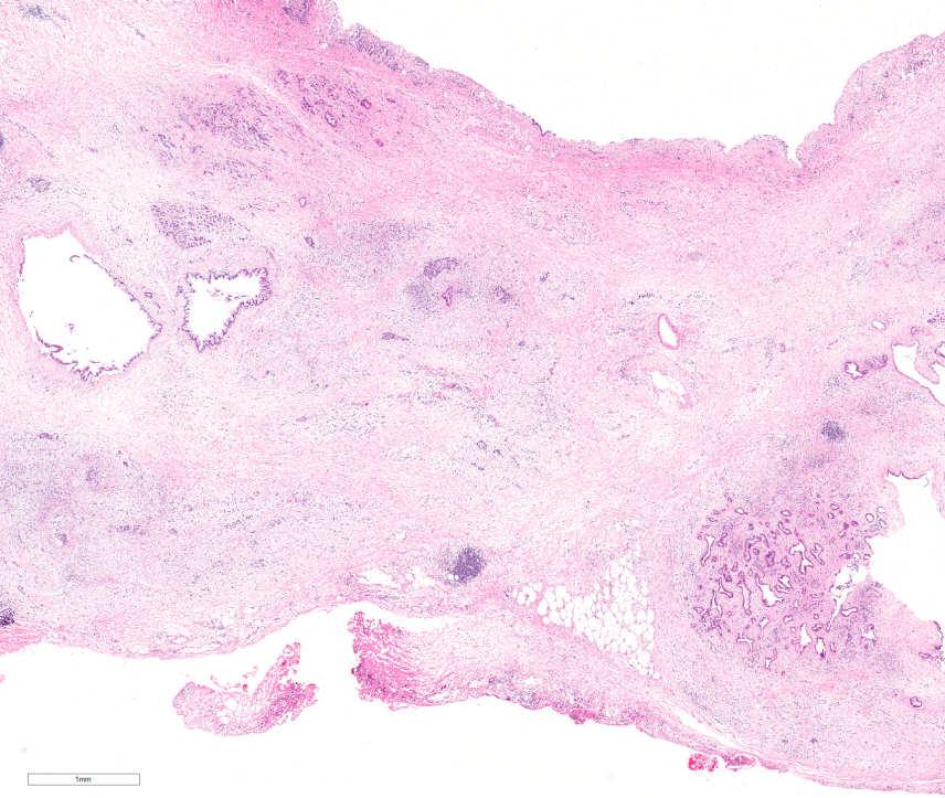 Pancreatic intraepithelial neoplasia (PanIN) Intraductal papillary mucinous