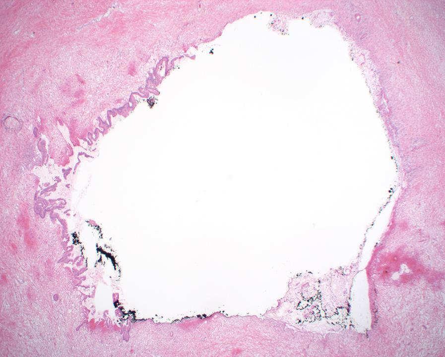 Pancreatic neck margin diagnosis case 1 Low-grade mucinous epithelium (low-grade
