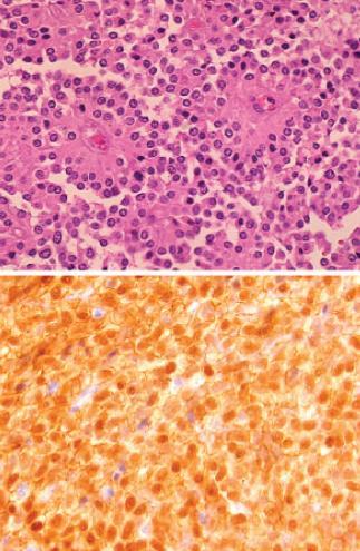 Solid pseudopapillary neoplasm (SPN) Young woman 10~15% : metastasis to liver, peritoneum or rarely lymph node vimentin, a1-antitrypsin, CD56 (+)
