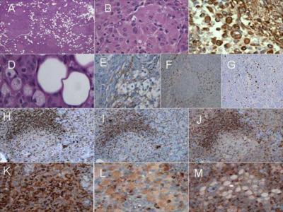 Figure 2 Figure 2: A. Nodular rhabdoid areas are seen in a background of atypical meningioma with lipomatous metaplasia; B.