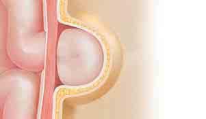 How a Hernia Develops A hernia bulge may appear suddenly. More often, they take years to form.