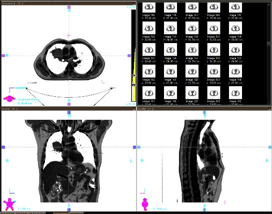 56 Volume 68 Algorithm (version 10.0.28) and the Pencil Beam Convolution (version 10.0.28) by Eclipse treatment planning system (Platform: 10) in Varian Medical Systems.