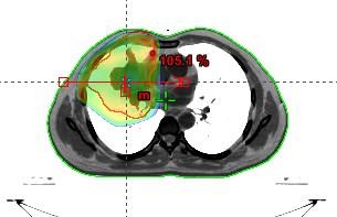 International Letters of Chemistry, Physics and Astronomy Vol. 68 57 Fig. 3. Figure shows profile and point dose for a 3DCRT isocentric technique lung cancer patient treated with 5 fields for AAA.