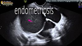 Ultrasound Can detect significant pathology such as fibroids,
