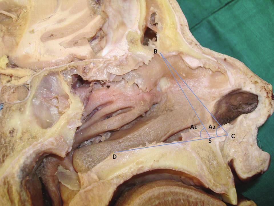In the region of the agger nasi ii. Into a space formed by the uncinate process postero-laterally and superior attachment of the middle turbinate anteriorly 2. Posterior to the uncinate process (Fig.