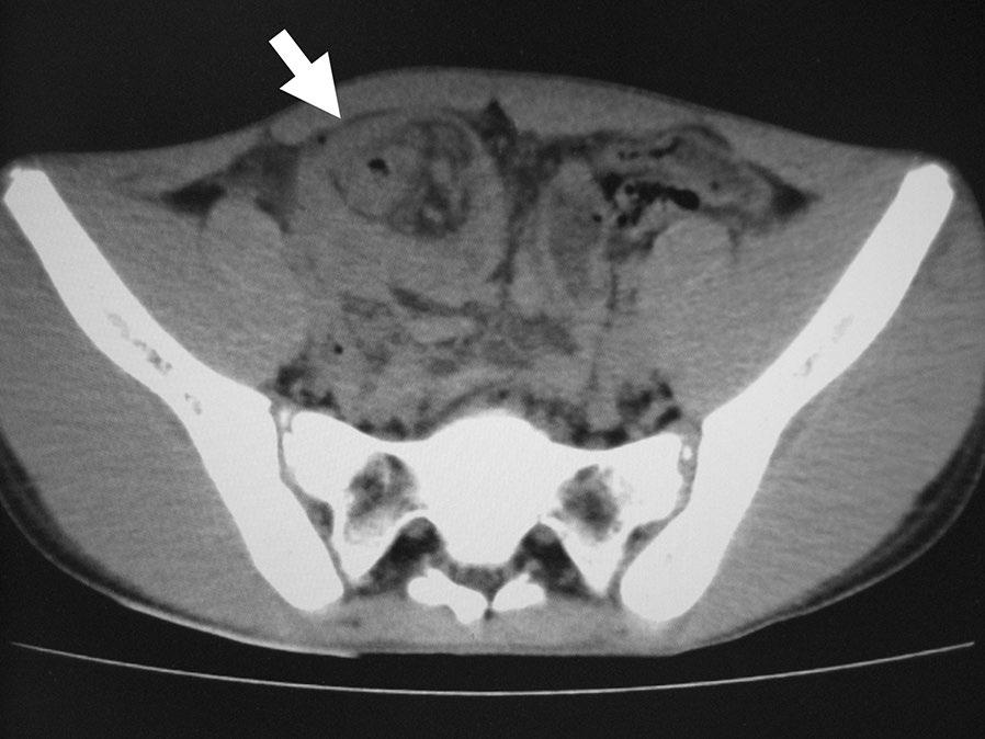 Enhanced computed tomography (CT) also revealed ileocolic intussusception with a suspicious looking mass (Figure 1).