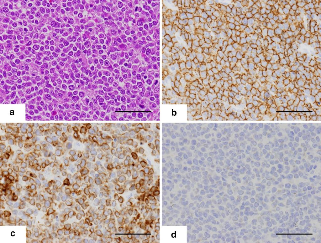 Page 4 of 5 Figure 5 Representative histological images of the tumor cells in the resected specimen. a Hematoxylin eosin (HE) stain. b d Immunohistochemistry. b CD20. c BCL2. d TdT.