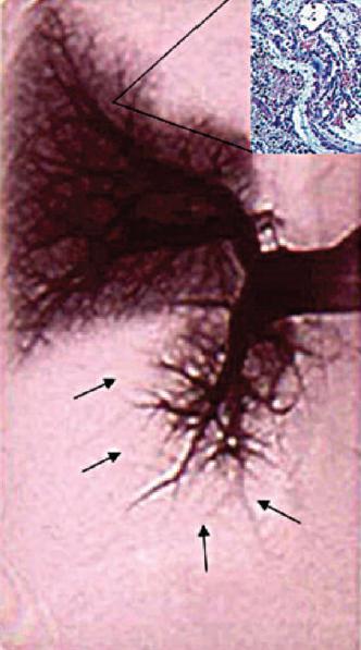 Background CETPH Chronic Thrombo Embolic Pulmonary Hypertension intraluminal thrombus organization and fibrous stenosis or complete obliteration of the pulmonary