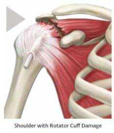 Shoulder Anatomy: The shoulder is made up of two joints, the glenohumeral joint and the acromioclavicular joint. The glenohumeral joint is where the ball (humeral head) and socket (glenoid) meet.