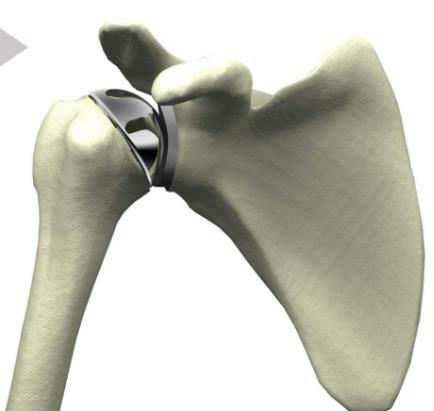 A total shoulder arthroplasty works by replacing the glenoid (socket) with a plastic concave cup, and the humeral head (ball) is replaced with a metal