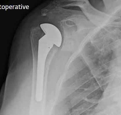 treatment of three different shoulder conditions 1) glenohumeral osteoarthritis in the presence of an irreparable rotator cuff, (2) complex fractures,