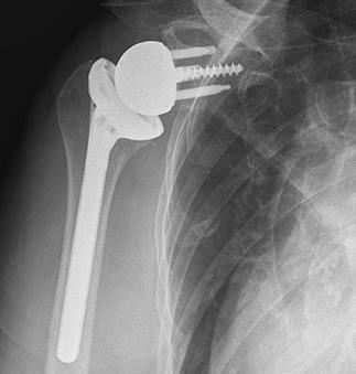 A reverse total shoulder arthroplasty works by replacing the glenoid (socket) with a glenosphere (ball), and replacing the humeral head (ball) with a