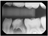 cavity = quick progression Gum with xylitol Pregnancy Hormone-induced gingivitis/periodontitis Red, swollen gingiva (gums)