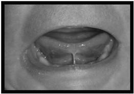Lingual Frenulum Labial Frenulum Ankyloglossia Tongue-tied Frenulum affects Breast-feeding Speech Oral cleansability Tongue range