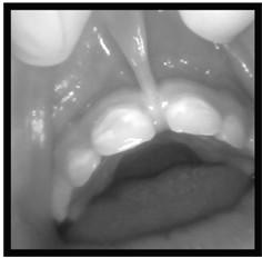 Diastema between anterior teeth Possible contributor to decay in primary front teeth Frenulum Treatment Frenectomy/frenulectomy