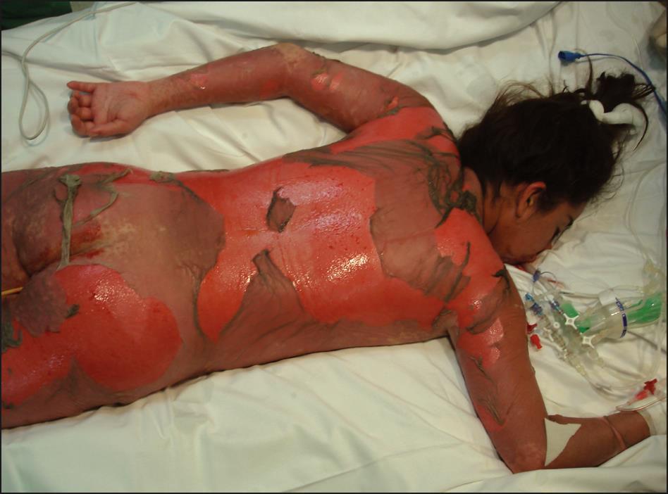 15 Adverse Cutaneous Drug Reactions. Medscape. http://reference.medscape.com/features/slideshow/drug-reactions#11. Widgerow AD. Toxic epidermal necrolysis - management issues and treatment options.