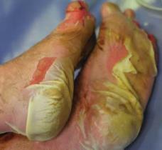 15 Adverse Cutaneous Drug Reactions. Medscape. http://reference.medscape.com/features/slideshow/drug-reactions#11. Harr T, French LE.