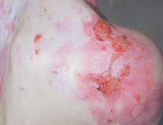 Patient 3: Chronic wounds at the shoulders of a teenager with EB showed